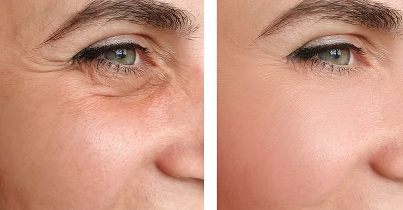 Choice Of Botox Injections National Deal Shafqa.com Online Shopping, Best Prices in Dubai UAE 3