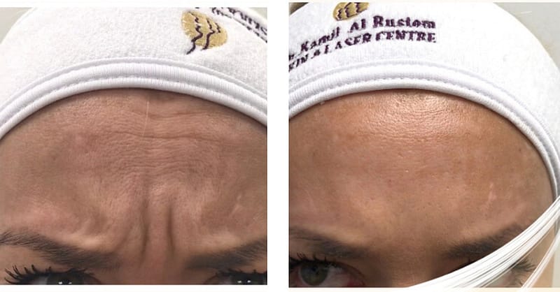 Choice Of Botox Injections National Deal Shafqa.com Online Shopping, Best Prices in Dubai UAE 4