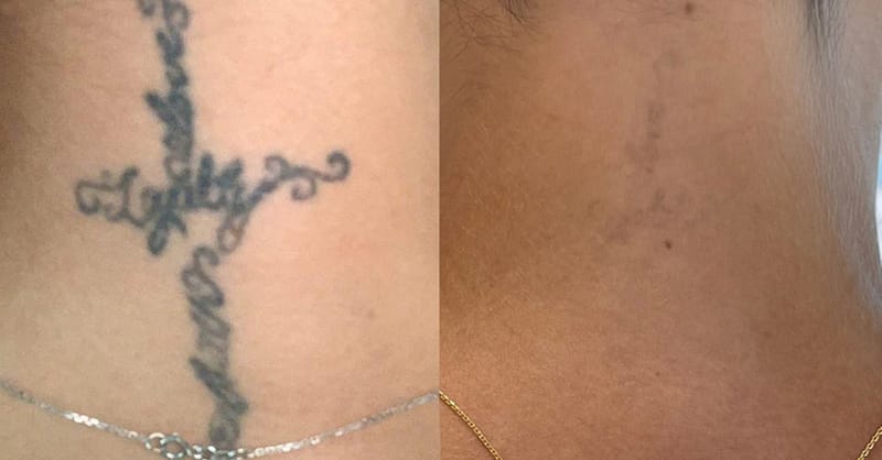 Three Sessions Of Laser Tattoo Removal: Small, Medium, Or Large Area Dubai Shafqa.com Online Shopping, Best Prices in Dubai UAE 4