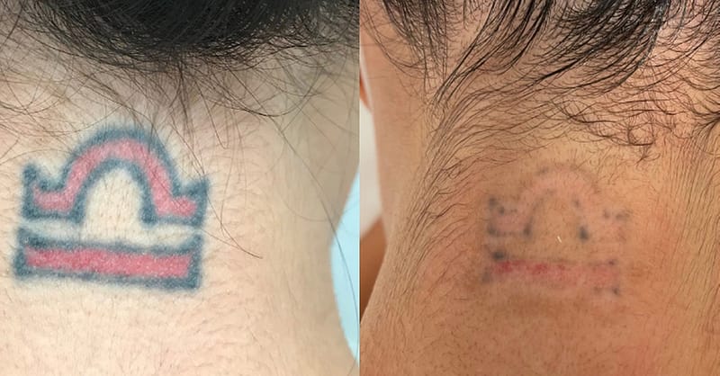 Three Sessions Of Laser Tattoo Removal: Small, Medium, Or Large Area Dubai Shafqa.com Online Shopping, Best Prices in Dubai UAE 6