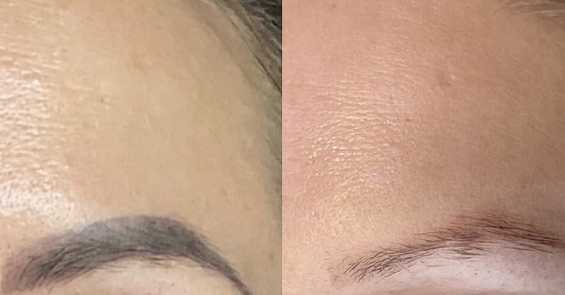 Three Sessions Of Laser Tattoo Removal: Small, Medium, Or Large Area Dubai Shafqa.com Online Shopping, Best Prices in Dubai UAE 7